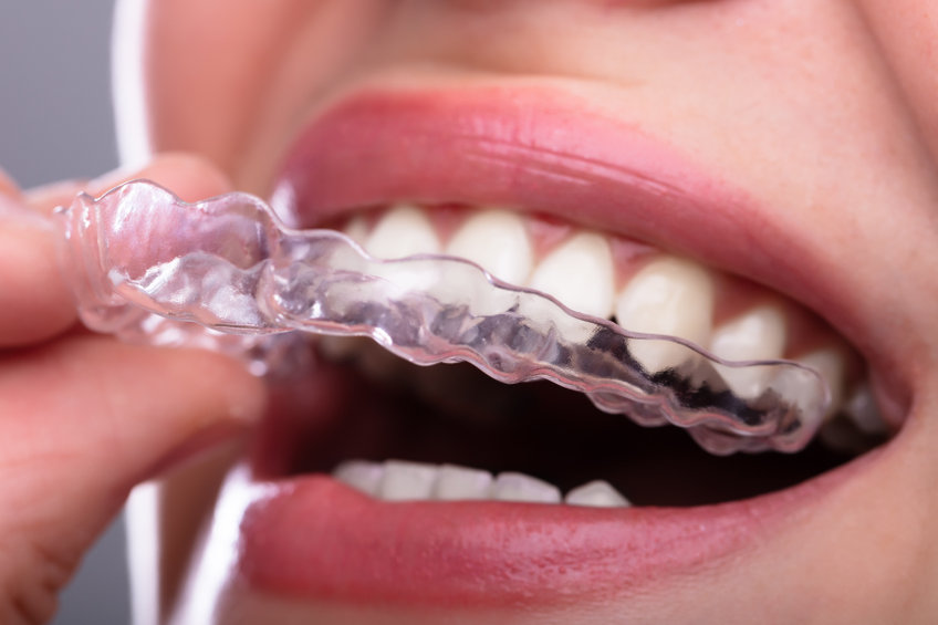 Quels sont les avantages à pratiquer l’orthodontie invisible ?